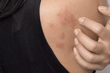 Allergy symptoms Itching 